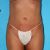 Fettabsaugung an Beinen mit 6 cm Unterschied pro Oberschenkel