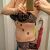 Fetabsaugung am Bauch: Fantastisches Ergebnis!