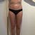 Besonders schönes Ergebnis nach Bodylifting + Renuvion®
