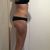 Besonders schönes Ergebnis nach Bodylifting + Renuvion®