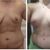 Erfoglreiches Mommy makeover - inkl. Bruststraffung mit Polytech 320 ml, Fettabsaugung an Hüften und Bauchstraffung