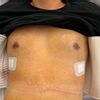 Schlechtes OP-Endergebnis durch zu geringe postoperative Kompression?