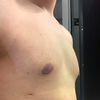 Schlechtes OP-Endergebnis durch zu geringe postoperative Kompression?