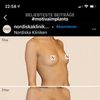 Motiva oder Nagor Implantate?