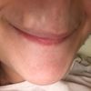 Entfernung von Wülsten und Granulomen nach Lippenvergrößerung  mit uma Jeunesse
