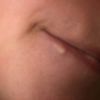 Entfernung von Wülsten und Granulomen nach Lippenvergrößerung  mit uma Jeunesse