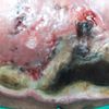 Nekrotische Narbe 6 Wochen nach Abdominoplastik
