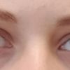 Asymmetrische Augen - kann man das "Problem" bei dem einen Auge beheben? :)