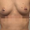Brustvergrößerung klein, Ballarina Boobs