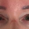 Andauernde Schwellung am rechten Auge, Asymmetrie 6 Wochen nach Oberlidstraffung