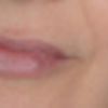 Asymmetrie nach Lippenunterspritzung