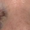 2mte nach Oberl.straffung, Augen öffnen sich Nachts