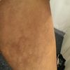 Verfärbte Beine 1 Jahr nach Fettabsaugung