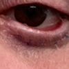 Linkes Auge nach Augenlidstraffung