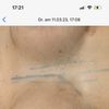 Bruststraffung mit Implantaten