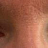 Asymetrische Augenlider / hängendes Augenlid, welche Korrekturen sind möglich?