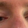 Asymetrische Augenlider / hängendes Augenlid, welche Korrekturen sind möglich?
