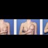 Brustvergrößerung - Brüste 9 Wochen nach OP ungleich, kann ich massieren/tapen?