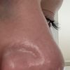Delle in der Nase nach Nasenop