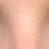 Asymmetrische Augenlider 