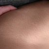Großflächige weiße Punkte an Hüfte Kniekehlen