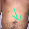 Linke Seite angeschwollener 7 Wochen nach Fettabsaugung am Bauch, Rücken und Brust