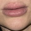 Hylase Lippen und Histamin?