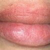 Hylase Lippen und Histamin?