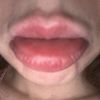 Lippen Revolax Angst Sorge