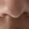 Nasenlöcher und Nase schief -5 Monate nach OP