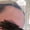 Unzufrieden mit der Stirnform/ gewünschte Stinrekonstruktion