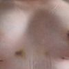 3 Wochen Post OP, linke Seite bereitet mir Sorgen. Tubuläre Brust