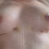 3 Wochen Post OP, linke Seite bereitet mir Sorgen. Tubuläre Brust