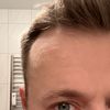 Lipofilling Augenpartie