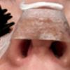 Asymmetrische Nasenlöcher nach Nasen OP?