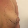 Tubuläre Brüste, Asymmetrie, verdrehtes Implantat 9 Monate post BV mit 395 cc ÜBM inkl. Brustwarzenstraffung