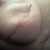Verformung nach Wiederaufbau der Brust nach Brustkrebs mit tropfenförmigem Implantat