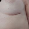 Euer Befinden 5 - 6 Wochen Post OP