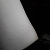 Dehnungsstreifen und Cellulite an Schenkeln und Po, 170 cm, 60 kg