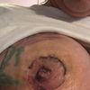 Implantaten wechsel Nekrose bekommen