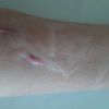 SVV-Narben/ Welche Behandlung?