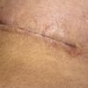 Eitrige Narbe nach Brustvergrößerung, soll ich bis zur Nachkontrolle warten?