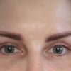 Oberlidstraffung mit leichtem Cat eye Effekt