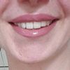 Schiefen Mund beim Lächeln behandeln mit Botulinumtoxin?