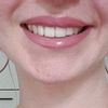 Schiefen Mund beim Lächeln behandeln mit Botulinumtoxin?