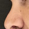 Assymetrische Nasenlöcher 3 Wochen nach OP, ändert sich das noch?