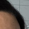 Stirnkorrektur / Barbie Forehead