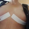 Über zwei Wochen post Op. Muss ich mir Sorgen machen?