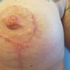 Veränderungen 3 Monate nach Brustvergrößerung mit anat.Impl.