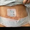 Bauchstraffung, Nerv verletzt, gehen die Schmerzen wieder weg?